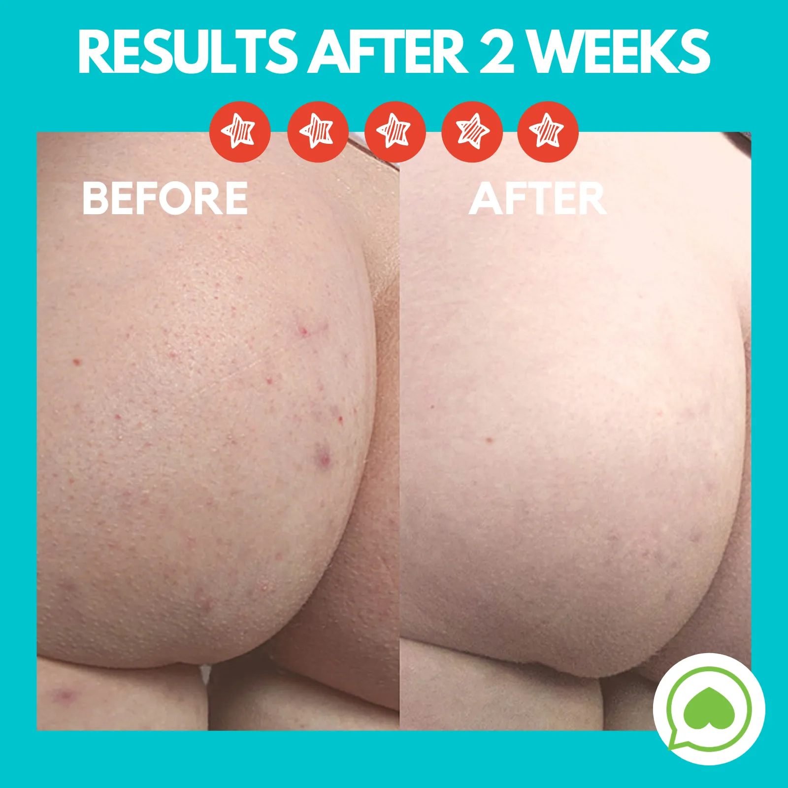 Butt Acne Clearing Lotion ® | Choose Your Size