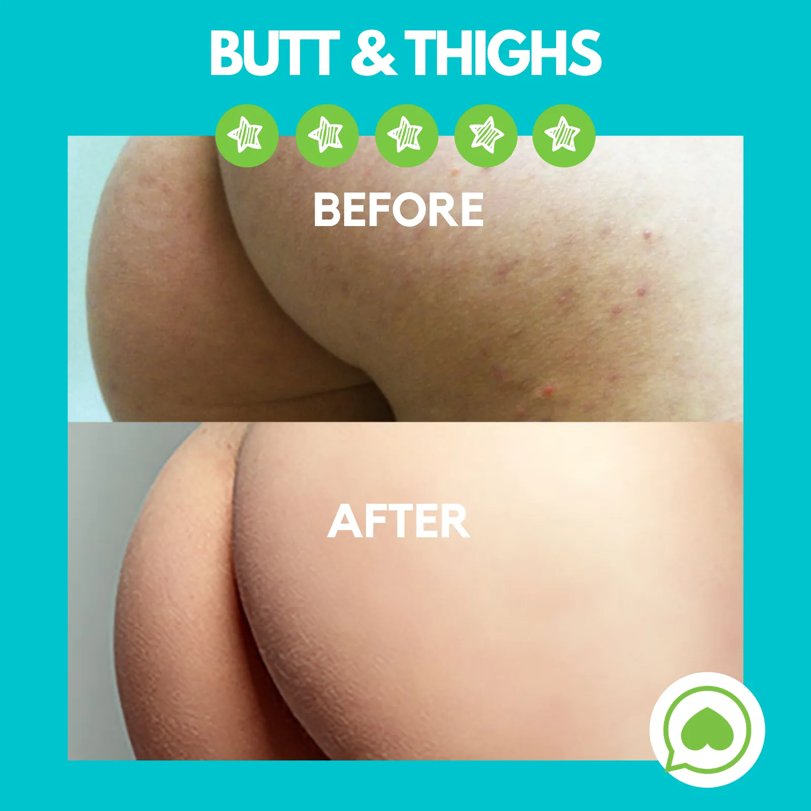 Butt Acne Clearing Lotion ® | Choose Your Size