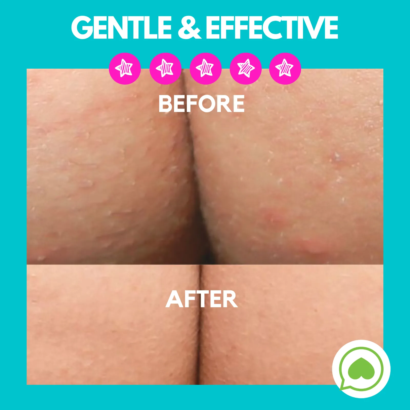 Butt Acne Clearing Lotion ® | Choose Your Size